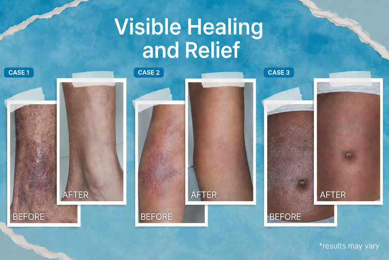 Before and after eczema cream transformation